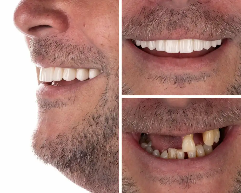 Before and after dental implant treatment restoring function and appearance.