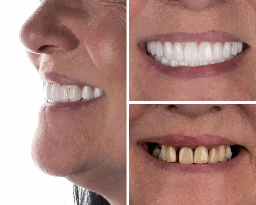 Before and after dental implant and crown treatment improving the patient's smile.