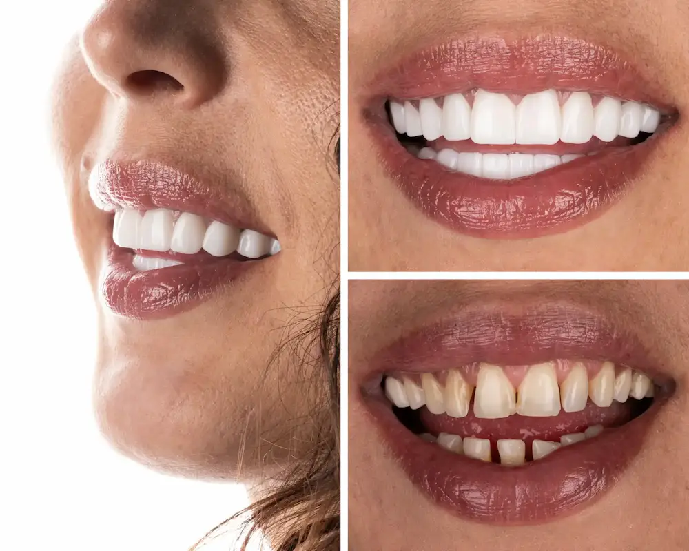Before and after full smile restoration performed at a partner dental clinic in Istanbul.