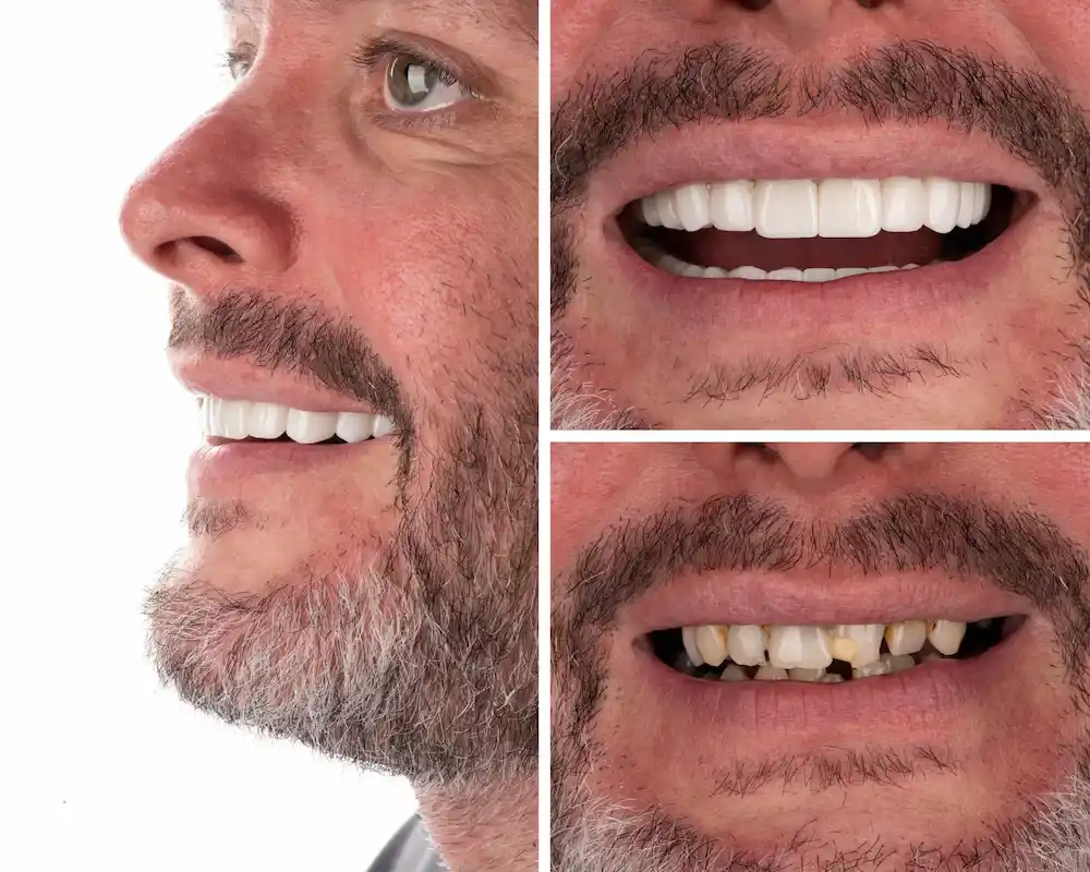 Before and after porcelain veneer treatment completed by one of our partner dental clinics in Istanbul.