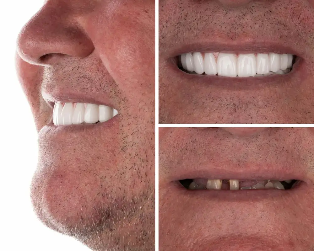 Before and after dental implant treatment bringing back the natural function and appearance.