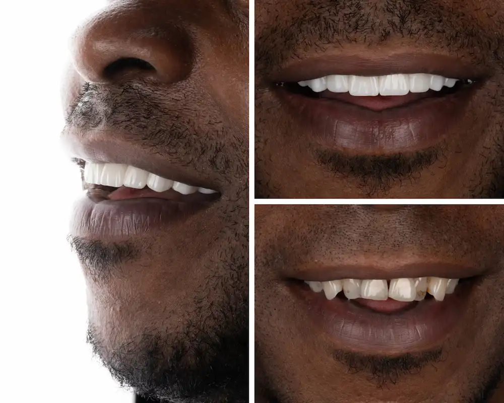 Great Results reached by porcelain veneer treatment completed by one of our partner dental clinics in Istanbul.