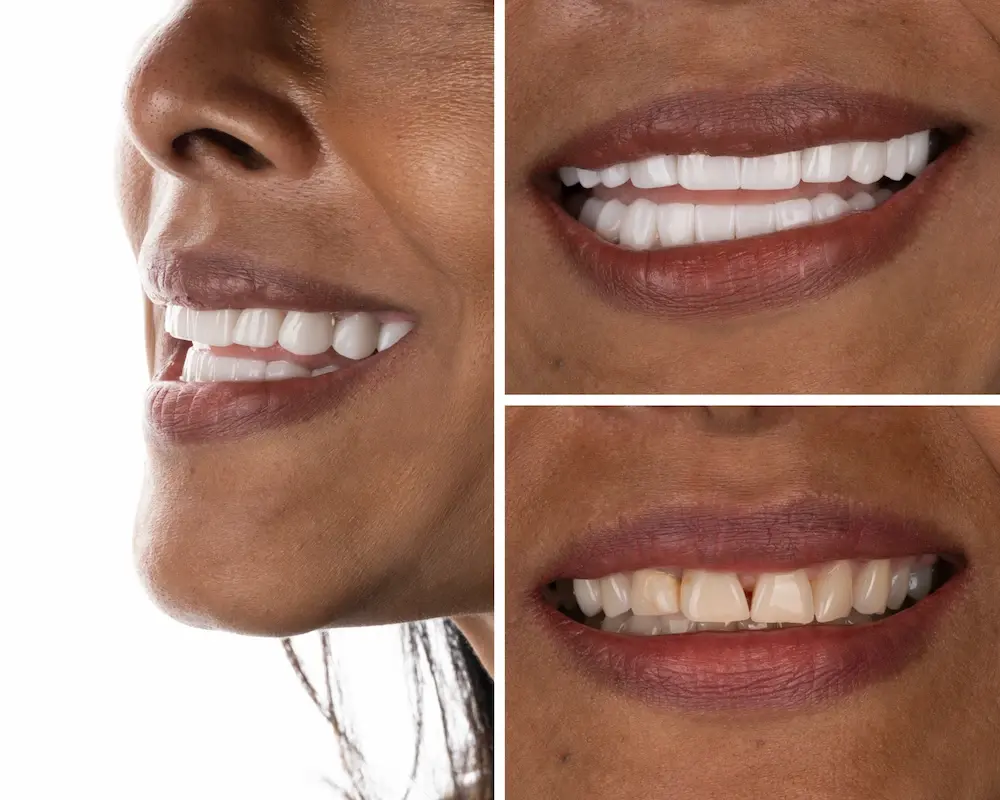 Great before and after full smile restoration done at a partner dental clinic in Istanbul.