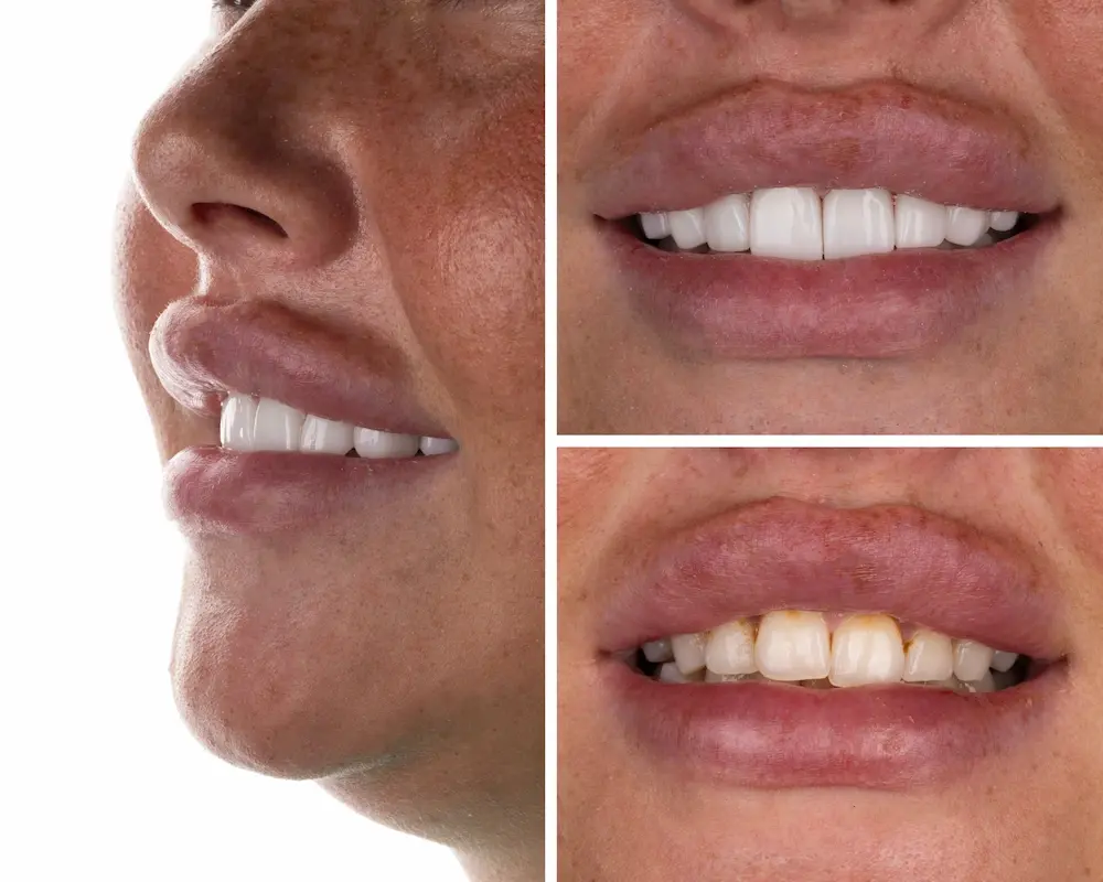 Before and after veneer treatment completed in of our partner clinics in Istanbul.